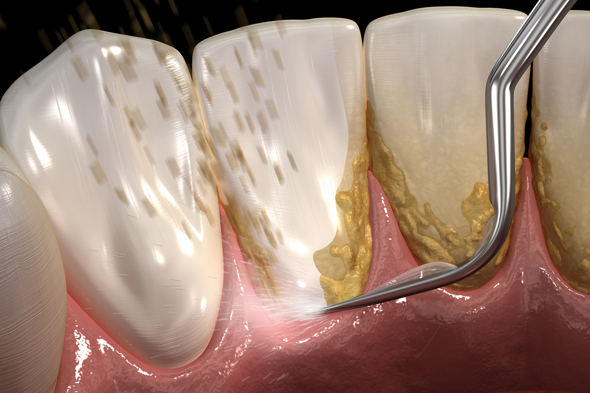 Zahnstein – wenn der Zahnbelag verhärtet