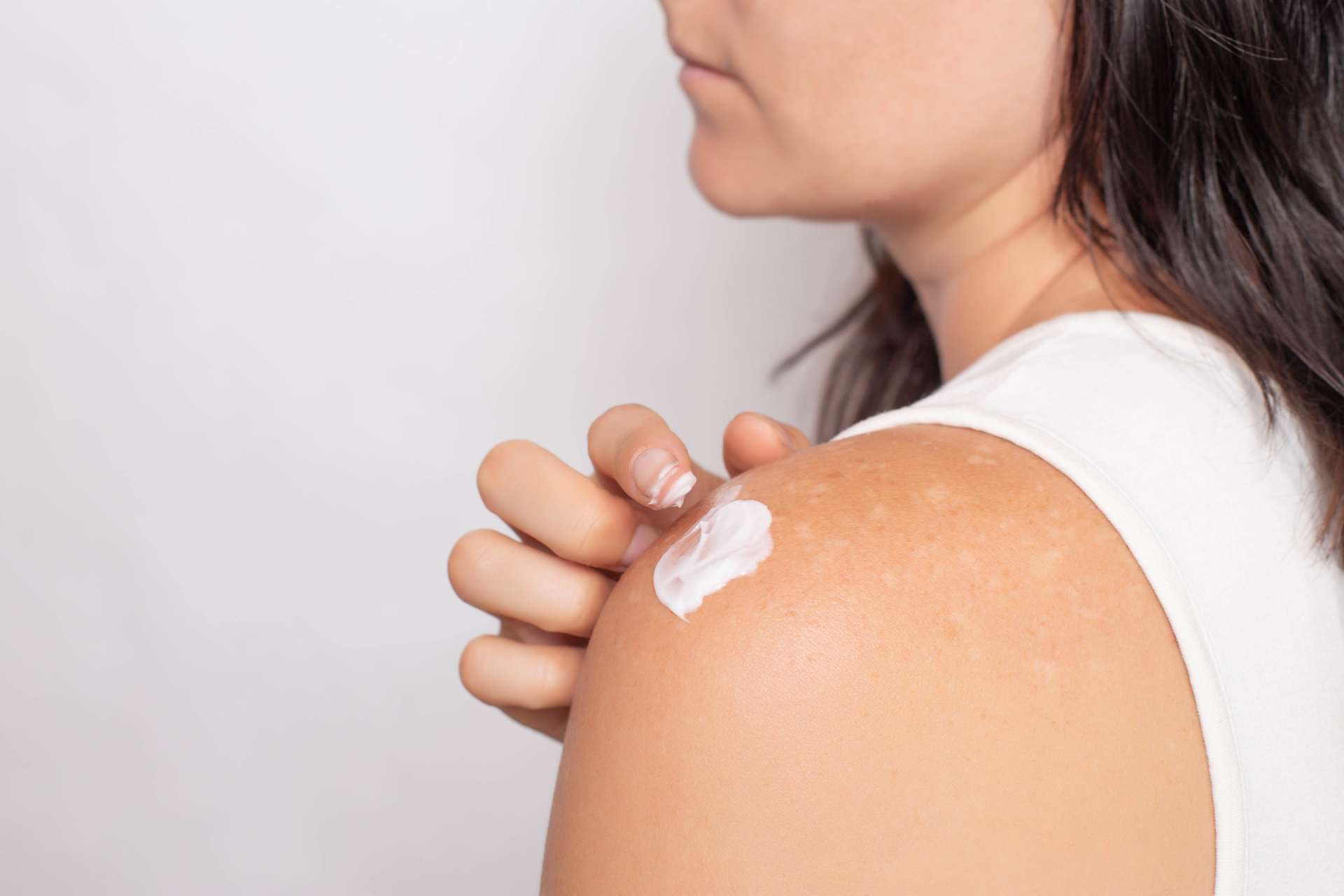 Pigmentstörung: Diese Menschen sind besonders häufig betroffen